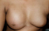 Breast Implant agra