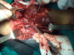 Micro Vascular Surgery