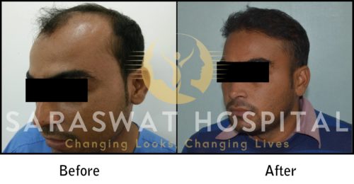 Hair Transplant in Agra India - Dr. Satya Saraswat