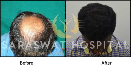 Crown Hair Transplant Before After Results