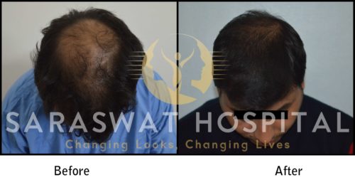 Crown Hair Transplant Results