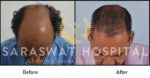 Hair Transplant Before and After Results in India