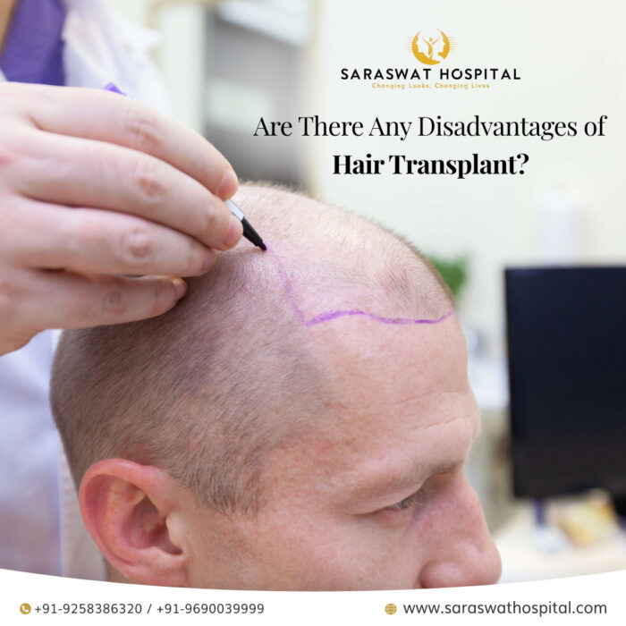 Are There Any Disadvantages of Hair Transplant