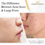 The Difference Between Acne Scars & Large Pores