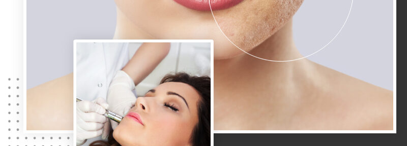 Most Effective Solutions for Acne Scar Treatment