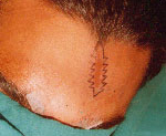 Scar Surgery