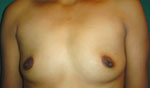 Breast Implant