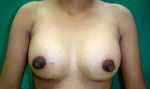 Breast Implant in Agra