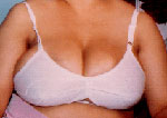Breast Reduction in Agra