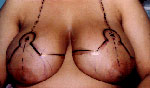 Breast Reduction Agra