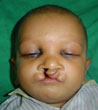 Cleft Lip Surgery Agra