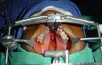 Cleft Palate Surgery in Agra