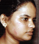Scar Surgery Agra