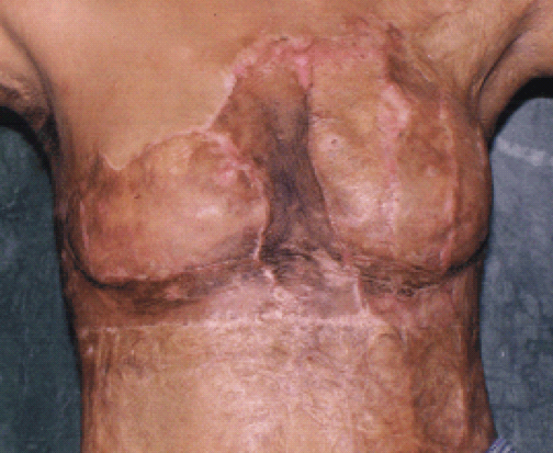 Nipple Areola Reconstruction
