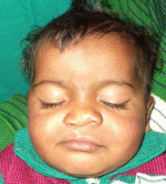 Cleft, Lip & Palate