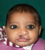 Cleft, Lip & Palate
