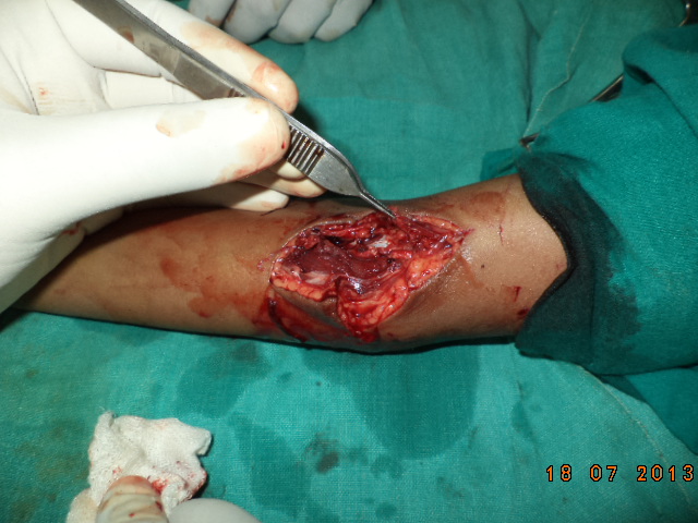 Micro Vascular Surgery