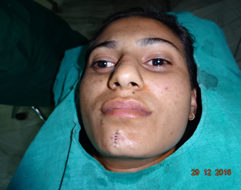 Scar Surgery