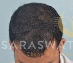 Mesotherapy for Hair loss