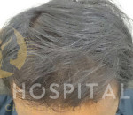 Mesotherapy for Hair loss