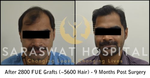 Hair Transplant Before & After Results | Saraswat Hospital