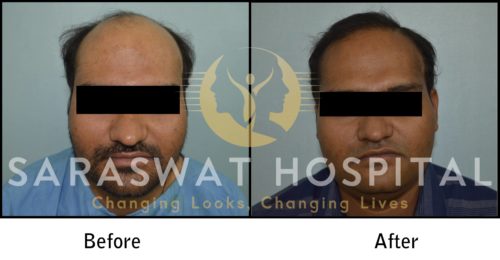 Hair transplant before after results 