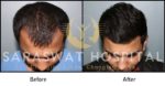 Hair Transplant Before and After Results in India
