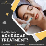 Acne scar treatment in Agra