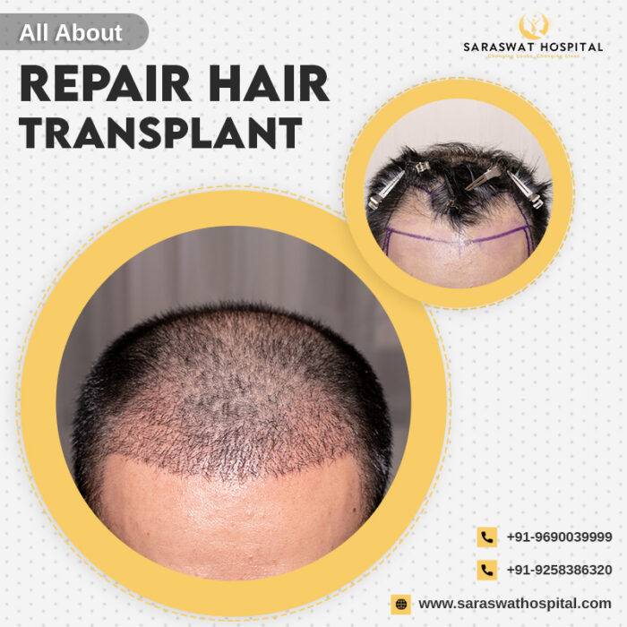 Repair Hair Transplant in India