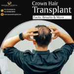Crown Hair Loss Treatment in Agra