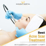 Best Acne Scar Treatment