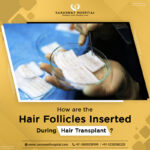 How are the Hair Follicles Inserted During Hair Transplant India