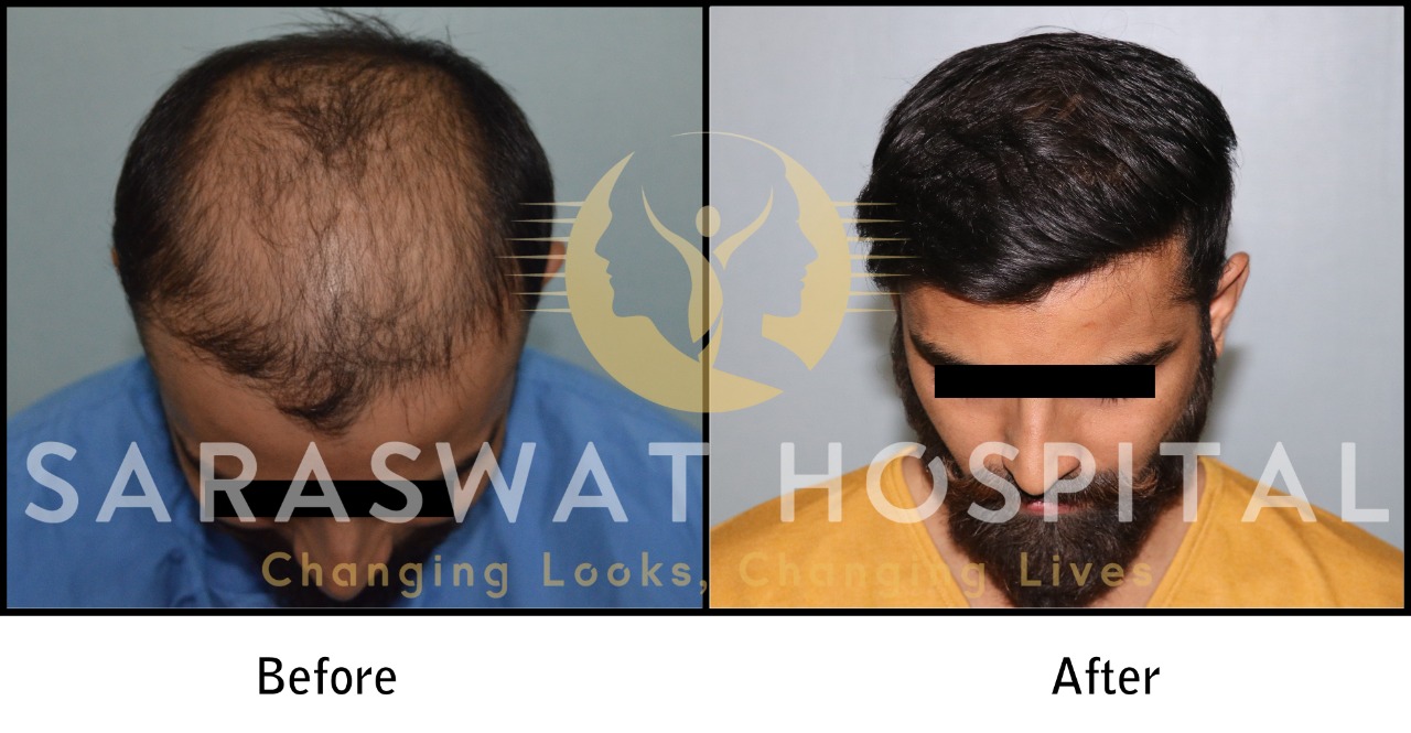 FUE Hair Transplant Results at Saraswat Hospital