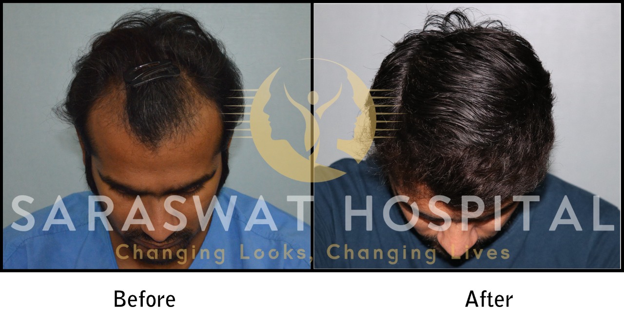 FUE Hair Transplant Results