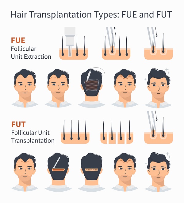 Types of Hair Transplant: FUE & FUT