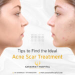 Find the Best Acne Scar Treatment for Yourself