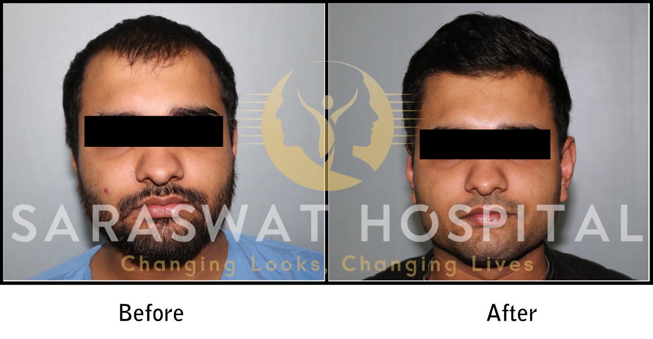 FUE Hair Transplant Results in India