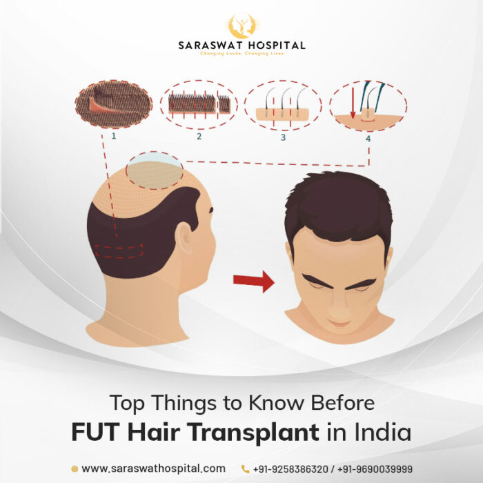 What Should You Know Before Opting for FUT Hair Transplant in India?