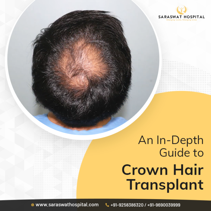 Crown Hair Transplant Surgery in India