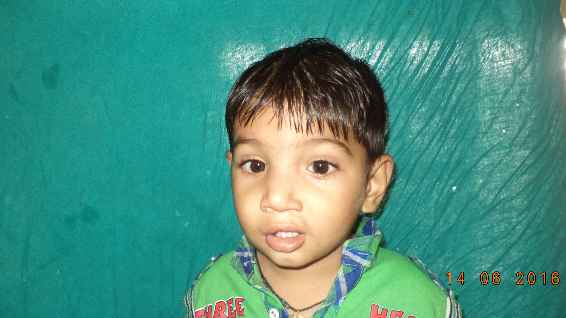 Cleft Lip Surgery in Agra