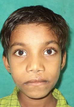 Cleft Lip Surgery in Agra