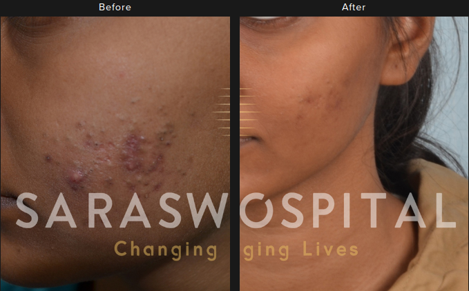 Acne Scars Treatment Results in Agra