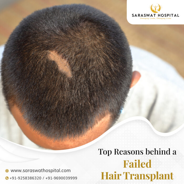 Hair Sure Hair Transplant Centre - Hyderabad, India • Read 7 Reviews