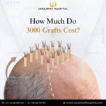 What is the Cost of Implanting 3000 Grafts in Hair Transplant