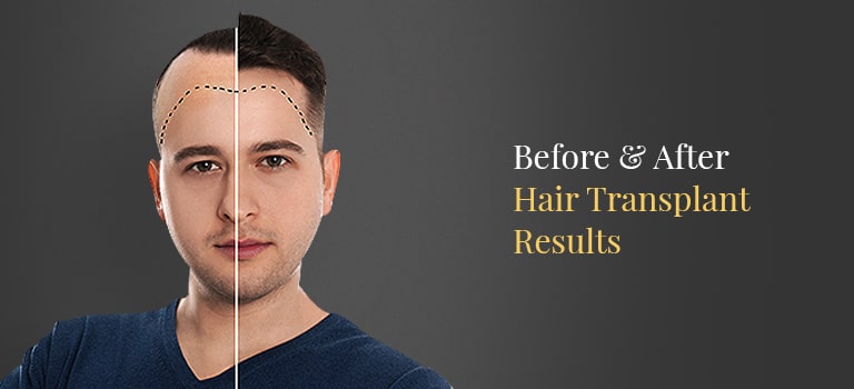 Hair Transplant Before & After Results | Saraswat Hospital
