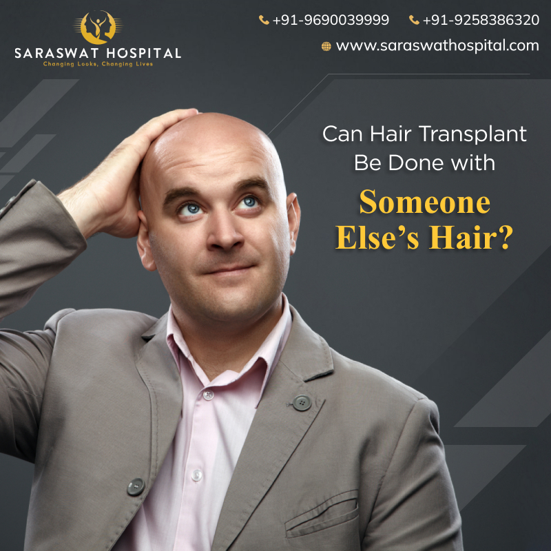 Can Hair Transplant Be Done with Someone Else’s Hair