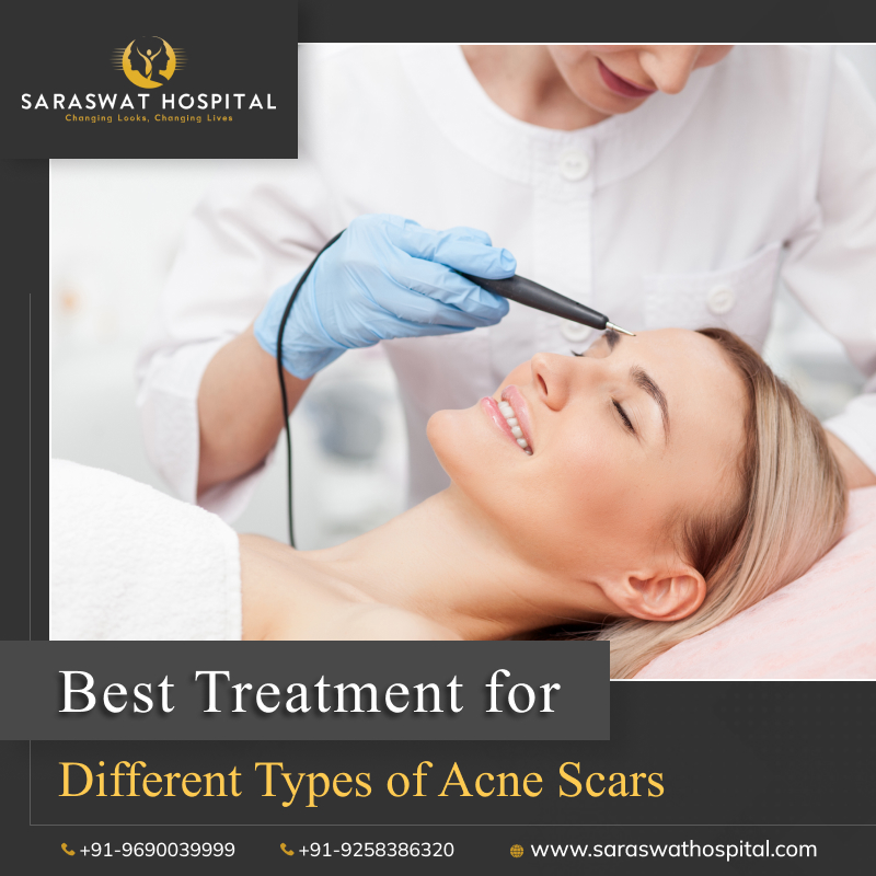 Types of Acne Scars and Their Best Treatment