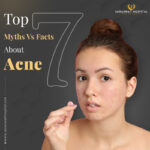 Busting the Most Common Myths About Acne