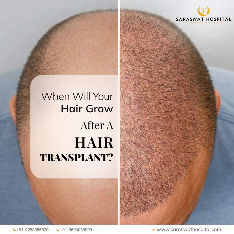 What is the Timeline for Hair Growth After Undergoing Hair Transplant?
