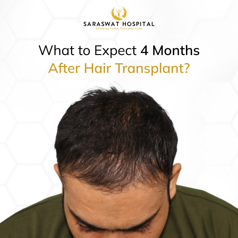 What to Expect 4 Months After Hair Transplant
